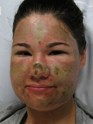 Foto divulgada por hospital mostra marcas do ataque com cido no rosto da americana Bethaby Storro