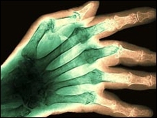 Pacientes com artrite reumatide tm risco menor de ter Alzheimer