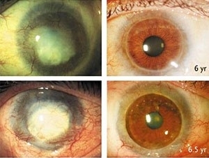Montagem mostra olhos de trs pacientes antes e Montagem mostra olhos de trs pacientes antes e