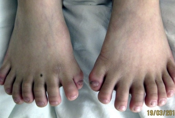 Garoto com 31 dedos passa por cirurgia na China