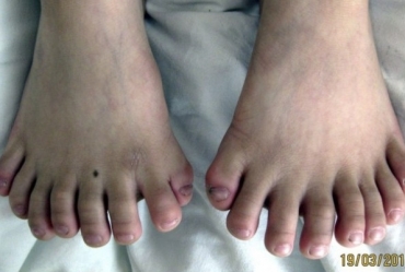 Garoto com 31 dedos passa por cirurgia na China
