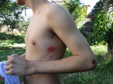 Jovem de 15 anos levou trs tiros de bala de borracha duranre confronto entre manifestantes e Polcia Militar