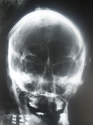 Radiografia do crnio de Marcos Matsunaga que consta na laudo da exumao ; empresrio levou tiro na cabea