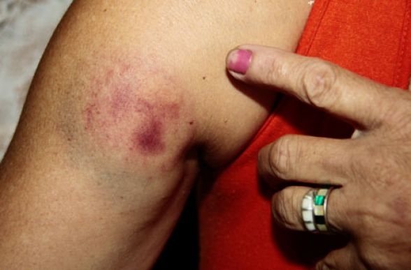 Mulher mostra marcas da agresso praticada pelo ex-marido; ele a mordeu nos 2 braos