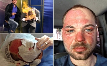 Ilusionista Wayne Houchin mostra seu rosto com as queimaduras sofridas durante gravao na Repblica Dominicana 