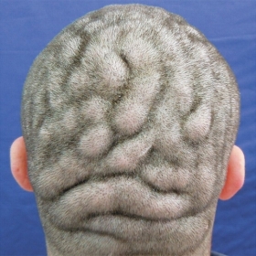 Couro cabeludo de paciente de 21 anos tem formato parecido com crebro