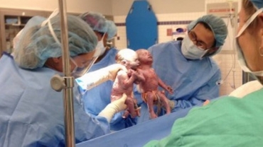 Jenna e Jillian nasceram prematuras de mos dadas Jenna e Jillian nasceram prematuras de mos dadas
