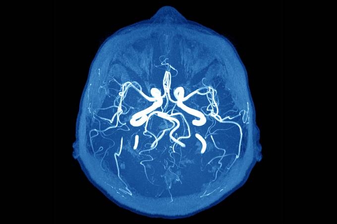 Existem 2 tipos de AVC: o isqumico, mais comum (80% dos casos) e causado pela obstruo dos vasos e o hemorrgico (caso de Marisa Letcia), que  menos comum, mas mais grave e acontece devido ao rompimento das artrias que irrigam o crebro. (iStock