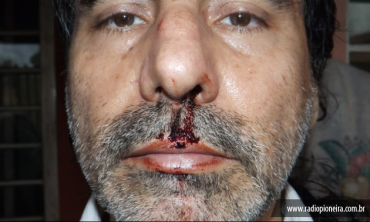 Jornalista Maurlio Trindade tirou foto do nariz dele com ferimentos depois da agresso (Foto: Maurlio Trindade/ Arquivo pessoal)