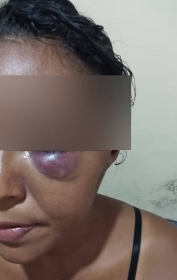 Mulher estava com vrios hematomas no rosto e no corpo  Foto: Delegacia Especializada de Defesa da Mulher de Cceres