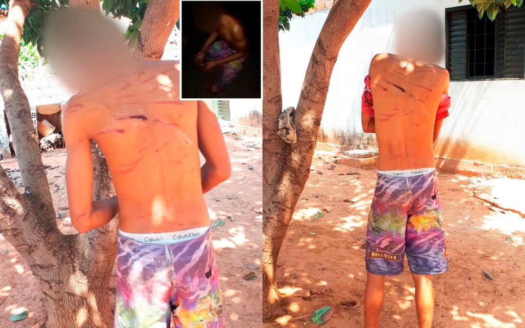 Sesso de tortura deixa marcas nas costas do rapaz de 20 anos, acusado de furtar em regio de domnio do Comando Vermelho, em Pontal do Araguaia