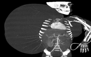 Imagem de raio X mostra o tumor que se desenvolveu na lateral do corpo do menino Jess Rodrguez, de 2 anos. 
