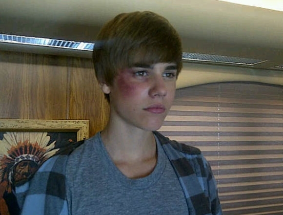 Justin Bieber tem reao alrgica leve e  levado a hospital na Califrnia