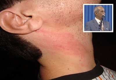 Jornalista ficou com marcas no pescoo aps ataque do vereador Jabuti (no detalhe)
