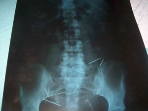 Objetos foram identificados na radiografia