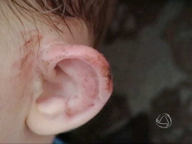 Detalhe de uma das orelhas atingidas pelas mordidas; criana ser operada aps se livrar de trauma psicolgico