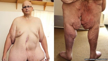 Ex-mais gordo do mundo apela a nudez em luta por cirurgia
