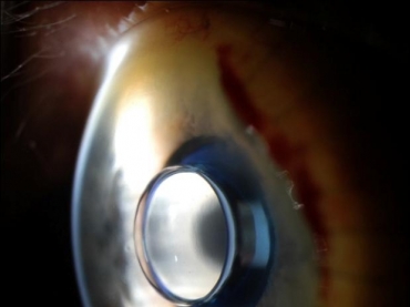 Micro-telescpio do tamanho de uma ervilha foi implantado sobre a retina.