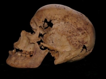 Esqueleto de mulher que viveu h mais de 4 mil anos foi analisado por cientistas, que detectaram evidncias do mais antigo caso de cncer de mama j registrado.