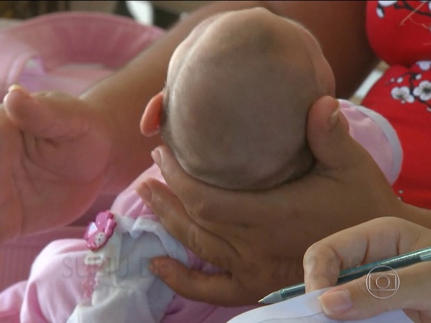 Notificaes de beb com microcefalia chegam a 1.546 em Pernambuco