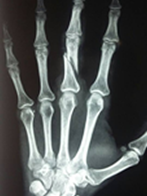 Raio-X mostra mo de mdica com dedo quebrado