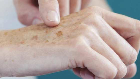De acordo com o oncologista clnico da Oncomed-MT, Giulliano Castiglioni, observar a pele regularmente  crucial para identificar leses suspeitas