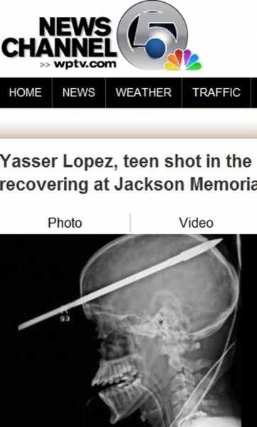 Imagem de raio-x mostra arpo de 46 cm que Yasser Lopez, 16, atirou acidentalmente contra a prpria cabea