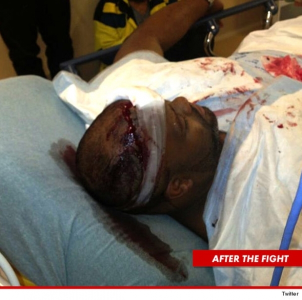 Segurana de Chris Brown machucado aps briga.