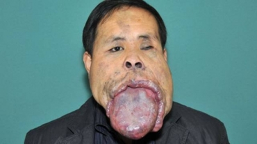 Wang Youping passou por vrios hospitais e ir demorar cerca de trs anos para ter uma lngua de tamanho normal 