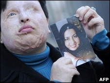 Iraniana quer punio equivalente para homem que a desfigurou