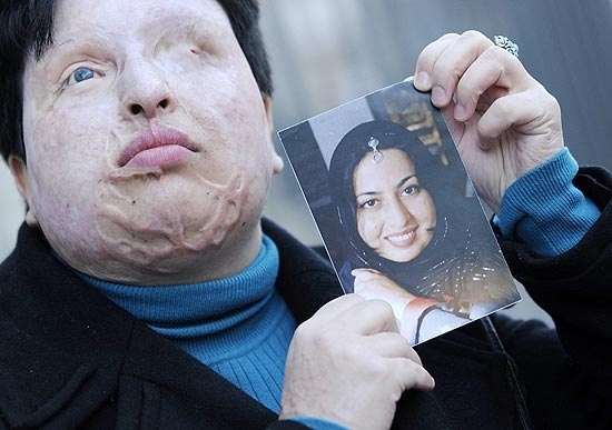 Em imagem de 2009, Ameneh Barani segura uma foto sua anterior ao ataque que a deixou cega e desfigurada