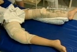 Garota de 11 pode ter a perna direita amputada.